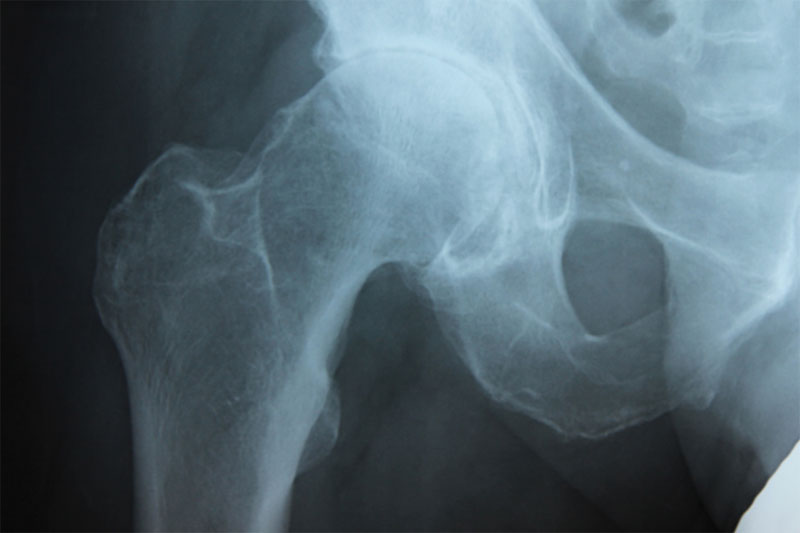 Hip Osteoarthritis