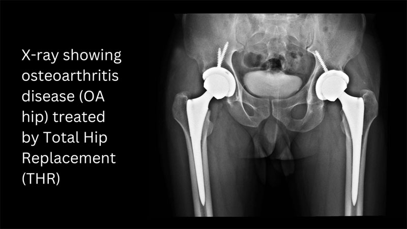 Hip Replacement